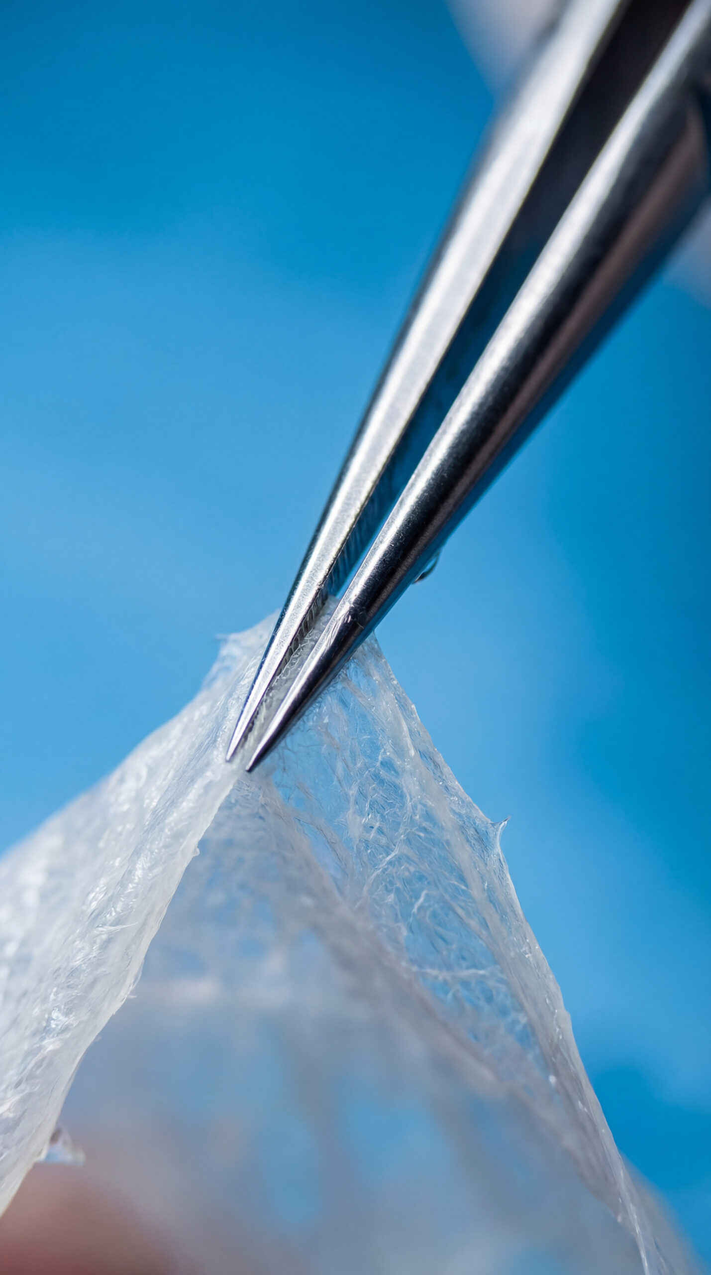 Cerrahi Kararı ve "Soyma" Tekniği (Kistektomi)